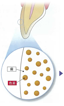 歯が変色した状態