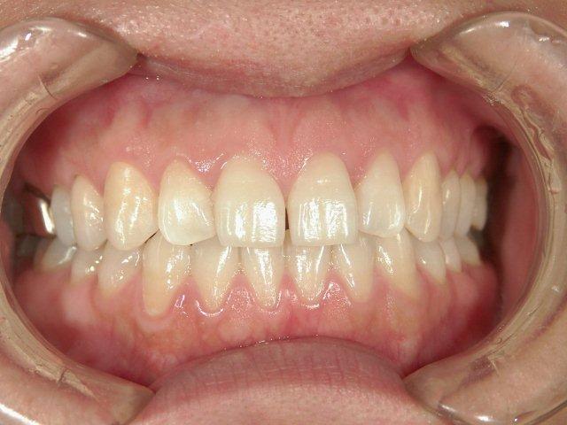 米子市TAKAデンタルクリニック歯科米子市ホワイトニング